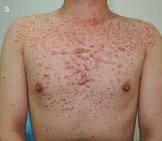 Monomorphic papules over the chest