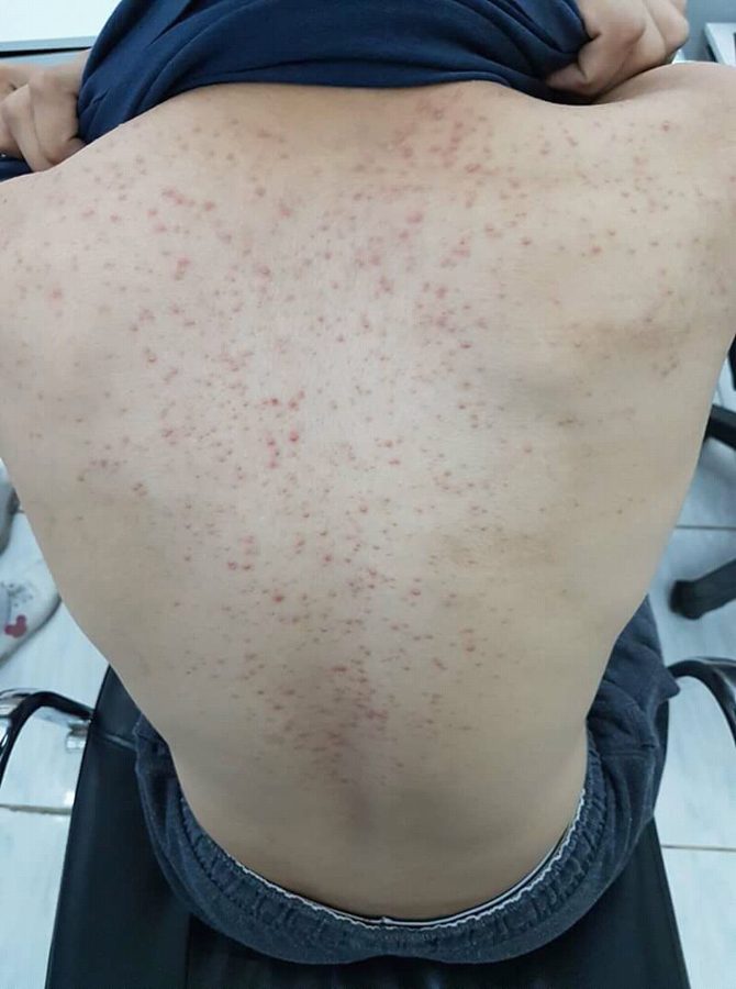 Uniform itchy papules across the back