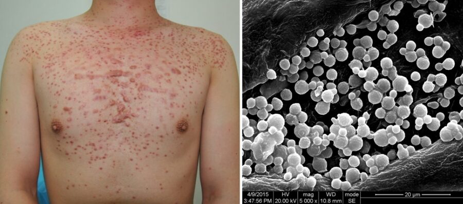 Malassezia (fungal) folliculitis of the trunk, with the yeast shown on electron microscopy