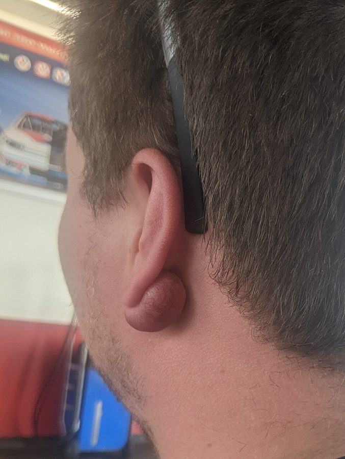 A keloid on the ear lobe after piercing