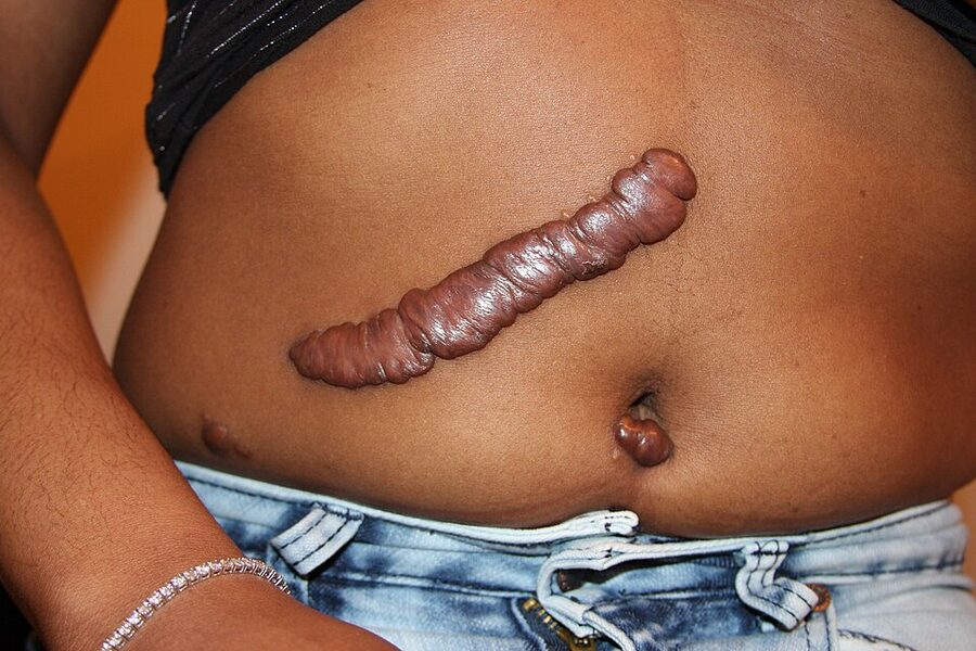 A keloid overgrowing the boundaries of the original surgical wound