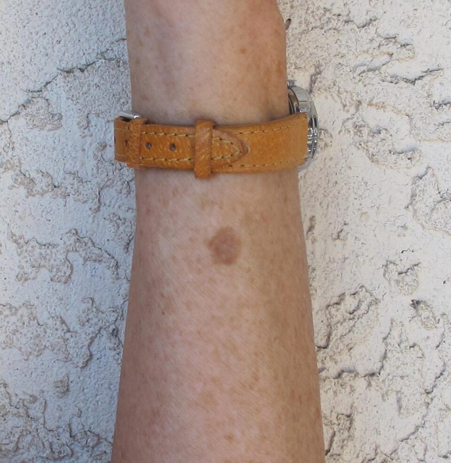 A solar lentigo on the forearm