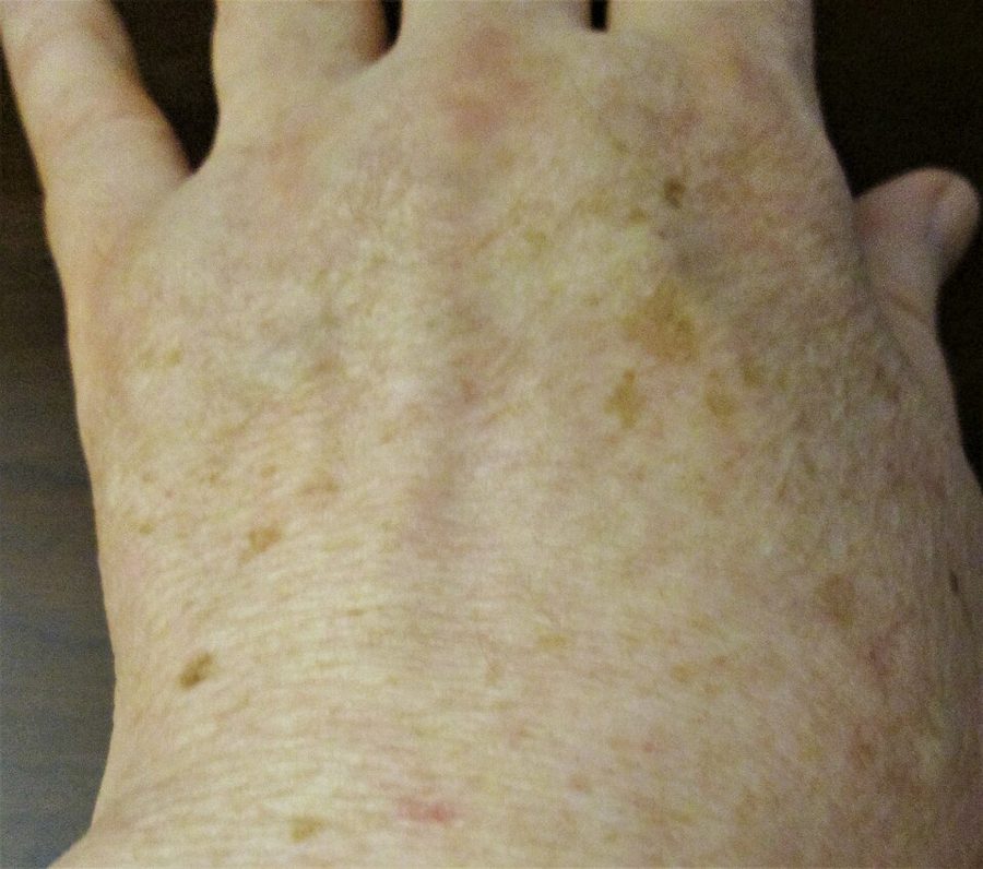 Widespread lentigines over the trunk and arms