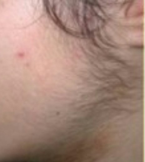 Dense sideburn and cheek facial hair before laser hair removal
